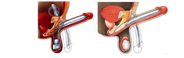 penis enlargement prostheses
