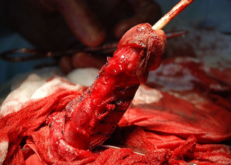 Penile implantation