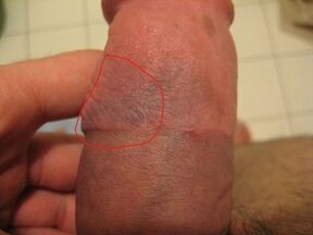hematoma on the penis due to improper use of the pump